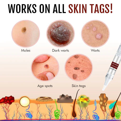 🎁BUY 1 GET 1 FREE🎁Tags & Moles Remover
